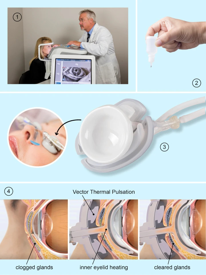 lipiflow thermal pulsation system a new dry eye treatment