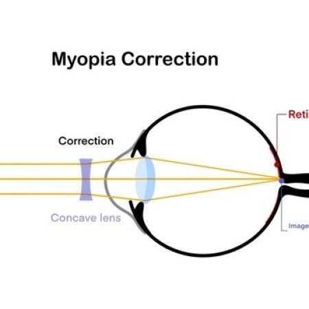 illustration-biology-physics-diagram-myopia-600nw-2586848309 illustration-biology-physics-diagram-myopia-600nw-2586848309