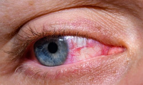 Dry eye syndrome, open eye with visible redness, sensitization, allergy Dry eye syndrome, open eye with visible redness, sensitization, allergy