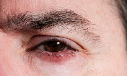 istockphoto-2197527290-612×612 Close-up of a male eye experiencing blepharitis, highlighting the redness and inflammation along the eyelid margin, causing discomfort and irritation