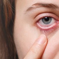 Medicine, health care and eyesight concept. Unrecognizable female shows her inflated red eye with blood capillary, has conjuctivitis. Woman with injured eye